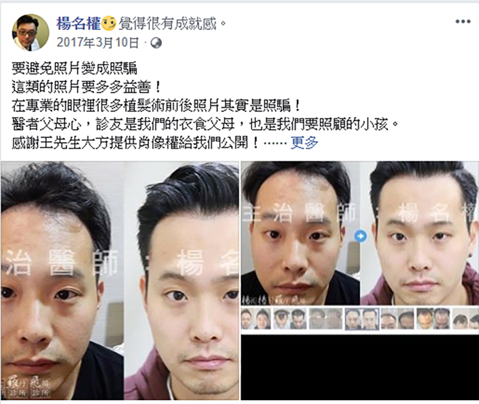 生髮613 落髮,掉髮,禿頭,楊名權